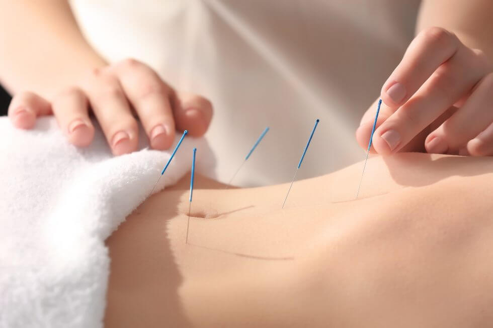 Acupuncture treatment
