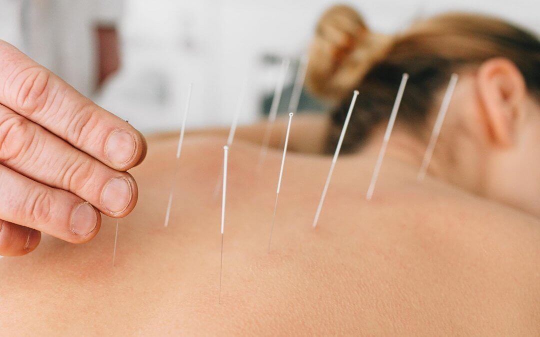 Common Acupuncture Myths Debunked