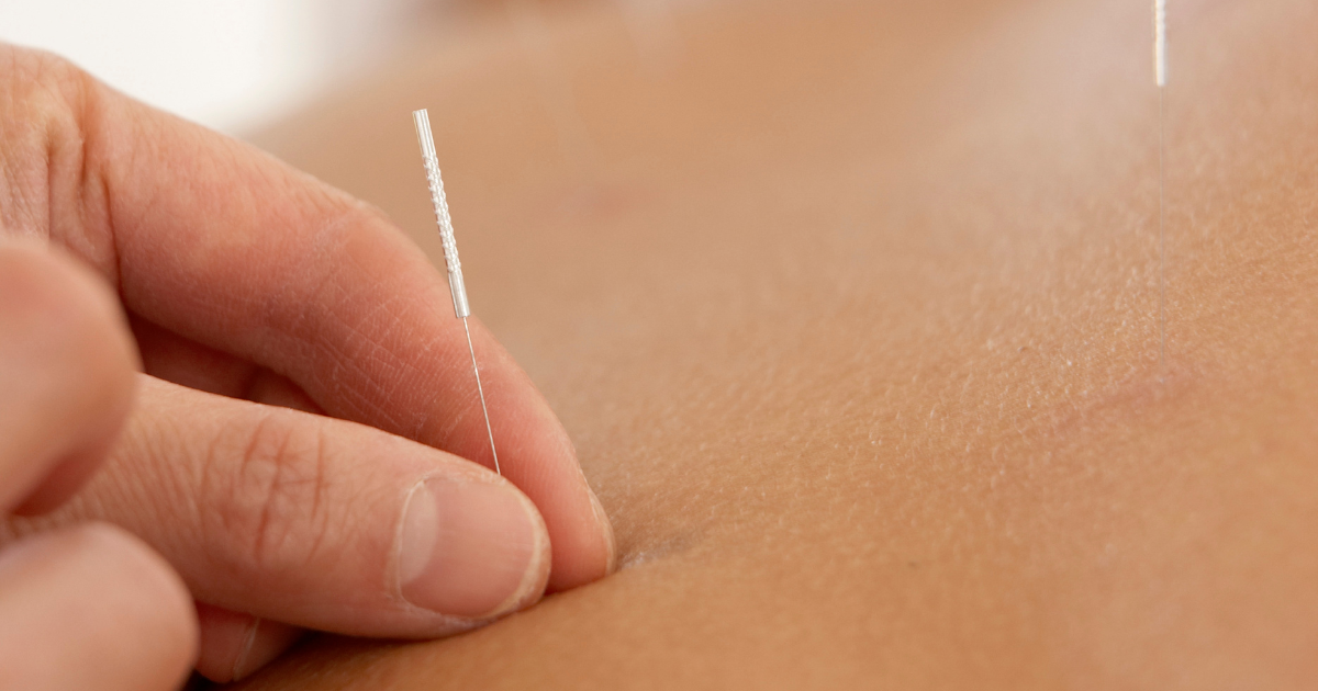 Acupuncture on the backside