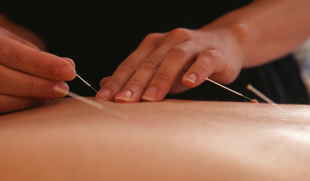 Acupuncture needles on the backside