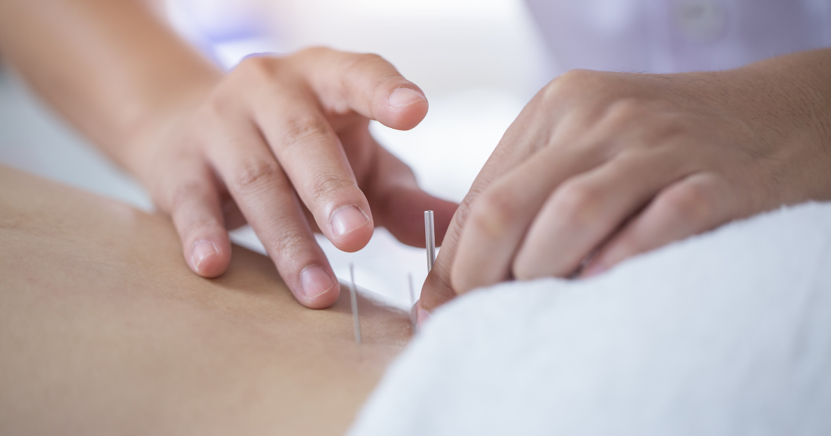 Acupuncture on the back