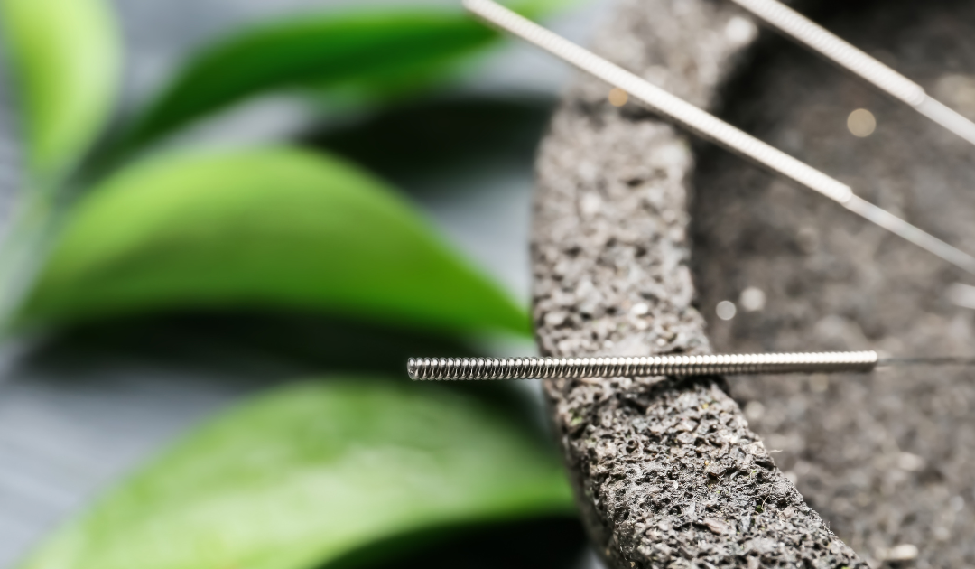Aesthetic closeup of the acupuncture needles